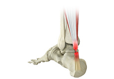 Achilles Tendon Rupture