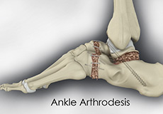 Subtalar Arthrodesis