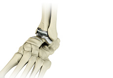 Ankle Joint Replacement