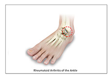 Ankle Rheumatoid Arthritis