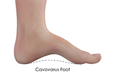 Cavovarus Foot Correction