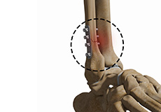 Complex Foot and Ankle Surgeries