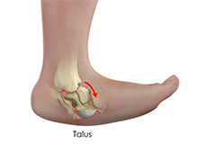 Congenital Limb Deformities