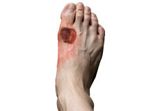 Diabetic Foot Conditions