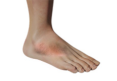Foot Inflammation