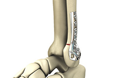 Internal and External Fixation of Foot and Ankle Fractures