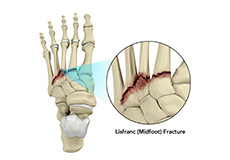 Lisfranc (Midfoot) Injury