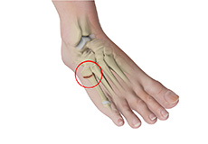 Metatarsal and Phalangeal (Forefoot) Fractures
