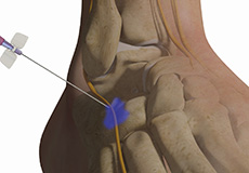 Neurolysis