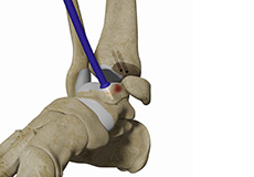 Osteochondral Allograft Transplantation System (OATS) of the Ankle
