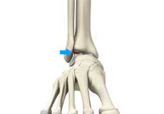 Osteochondral Injuries of the Ankle