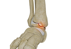 Osteochondral Lesions of the Ankle