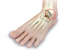 Foot Rheumatoid Arthritis