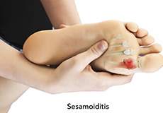 Sesamoiditis