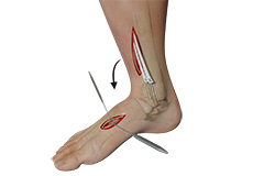 Tendon Transfer